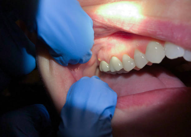Best Dentist for Tooth Abscess  in Woodmoor, CO